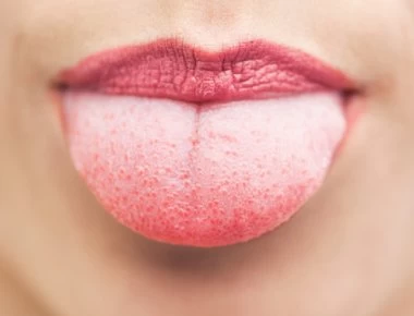 Τι αποκαλύπτει το χρώμα της γλώσσας σας για την υγεία σας